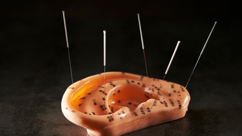 Auricular Approach to Shoulder Pain and Dysfunction