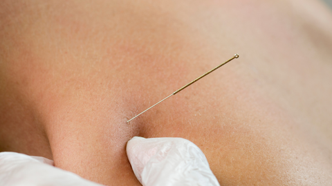 Out-of-the-Box Dry Needling